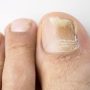 Nail Polish Foot Fungus Prevention & Treatment