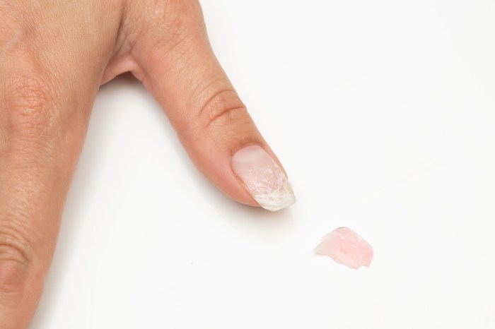 Peeling causes fingernails