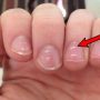 White Spots on Nails After Removing Polish